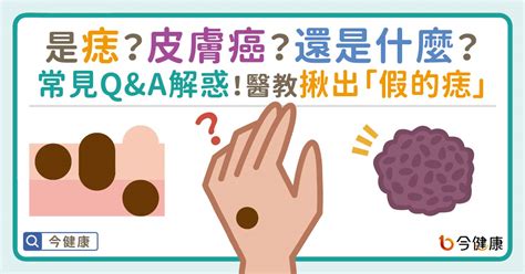 乳頭長痣|是痣？皮膚癌？還是什麼？常見Q&A解惑！醫教揪出「。